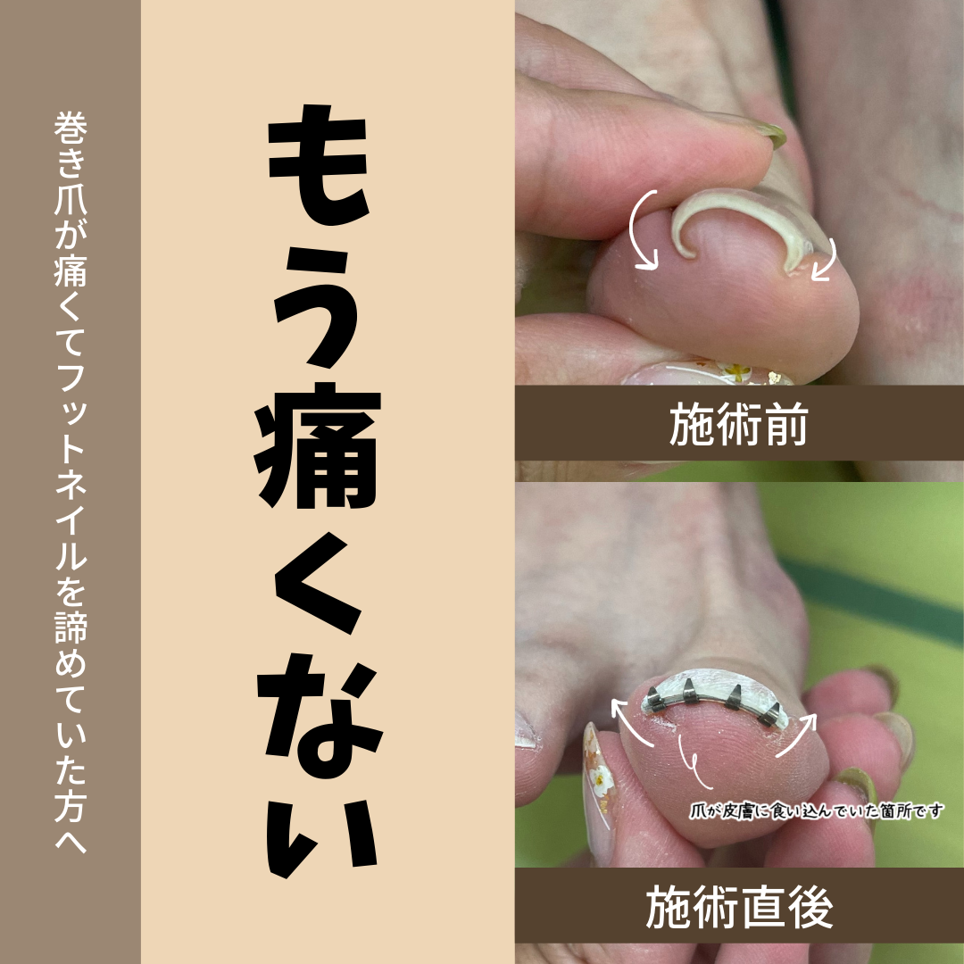 ネイルクリーナー　爪垢取り　フットネイル　ステンレス製　爪のお掃除　爪垢　巻き爪